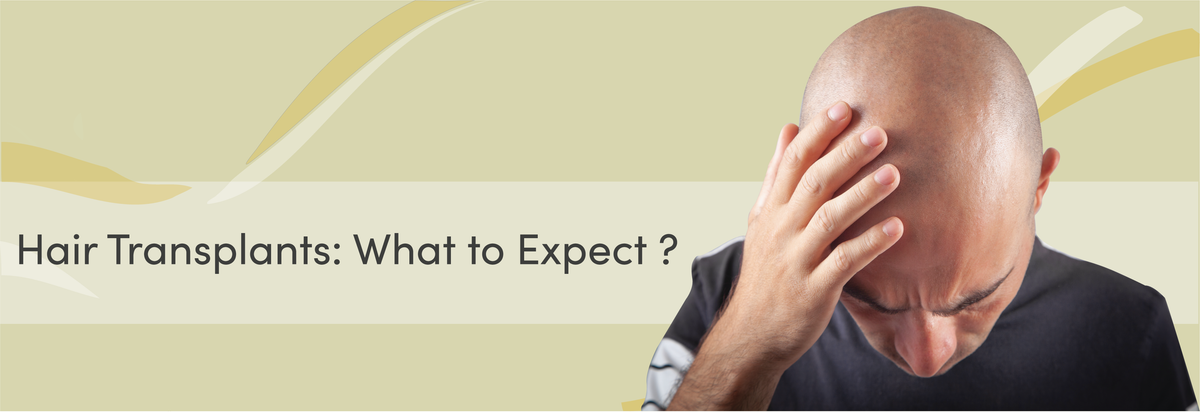 Hair Transplants: What to Expect